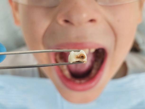 Best Emergency Dentist for Lost Fillings or Crowns in Moody, TX